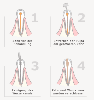 Wurzelkanalbehandlung - Stadien